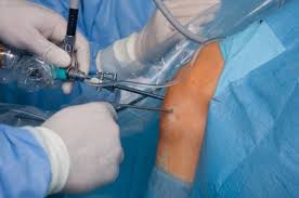 Arthroscopic Knee Surgery