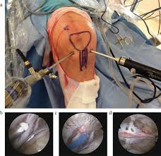 Knee Arthroscopy Procedure