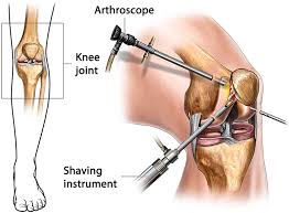 Arthroscopic Knee Surgery