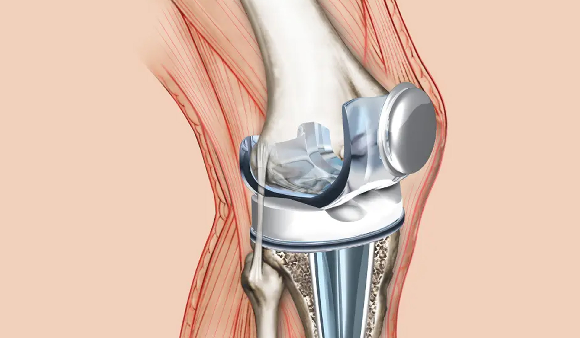Advanced Joint Surgery