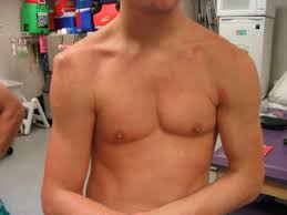 Shoulder Dislocation Treatment