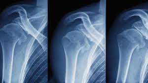 Shoulder Injury Care